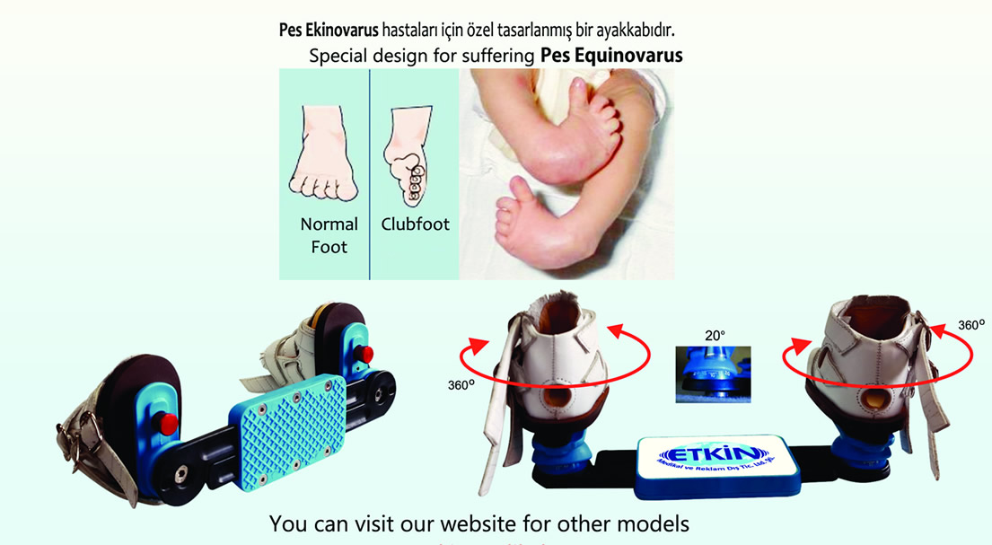 Club Foot Shoe with Splint Bar - Best Effective Treatment